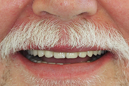 Nachher
